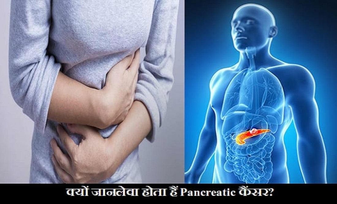 कब खतरनाक हो जाता हैं Pancreatic Cancer, इन लक्षणों को गलती से भी नहीं करना चाहिए नजरअंदाज!