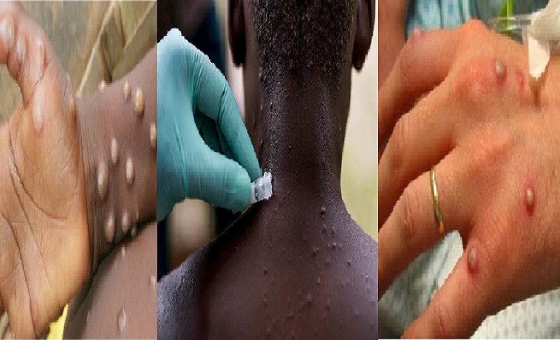 Monkeypox pandemic, World health network