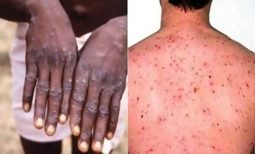 एक बार फिर बढ़ा डर: कोरोना से भी खतरनाक बीमारी ने दी दस्तक! जानिए Monkeypox कैसे होता है और क्या है इसके लक्षण?