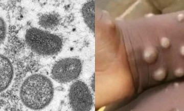 Monkeypox: मंकीपॉक्स के फैलते प्रकोप को देखते हुए WHO ने घोषित किया ग्लोबल हेल्थ इमरजेंसी, केरल के बाद अब राजधानी दिल्ली में मिला पहला मरीज