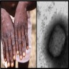 mokeypox spreading by sex, prevention, 