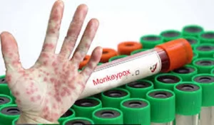 Monkeypox from Africa spreading panic all over the world