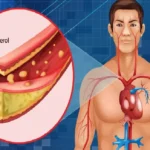 High Cholesterol, High Cholesterol symptoms