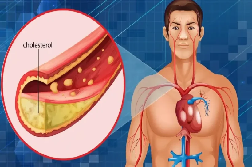 High Cholesterol, High Cholesterol symptoms