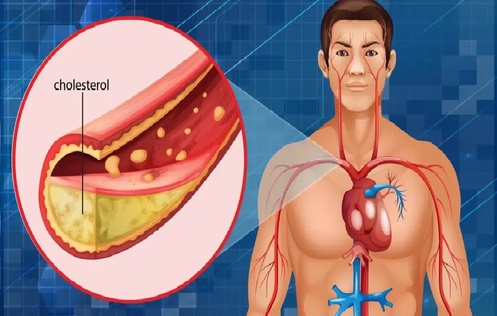 High Cholesterol, High Cholesterol symptoms