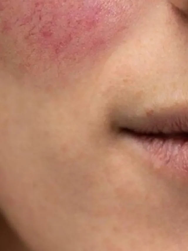 सर्दियों में फटे गालों से पाएं छुटकारा,अपनाएं ये 5 जादुई घरेलू नुस्खे