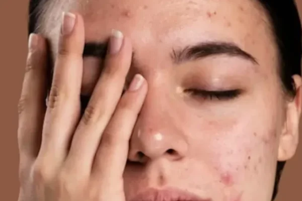 Dry Skin in winter, Remedies for Dry Skin in winter