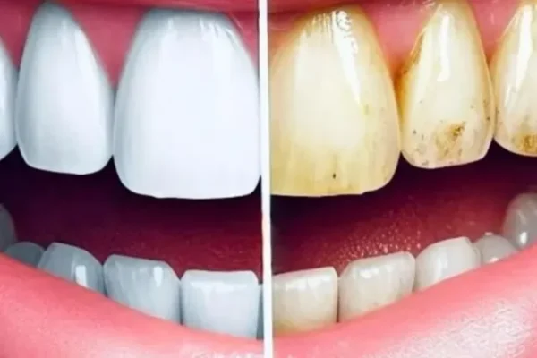 Whitening teeth, Whitening teeth Home remedies