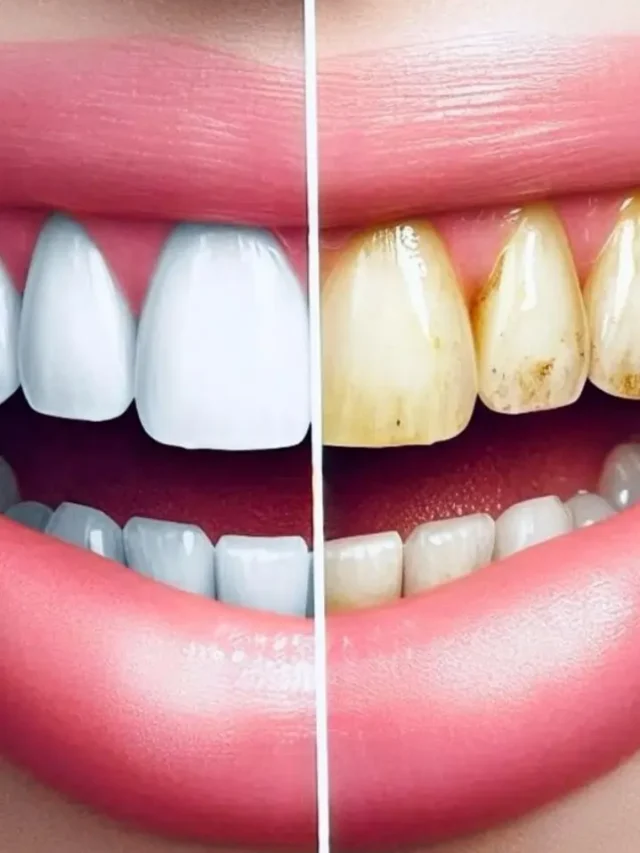 दांतों का पीलापन दूर करने के रामबाण उपाय