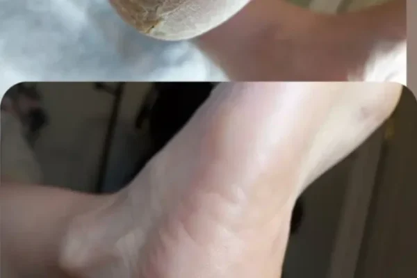 Ankle, Ankle repair