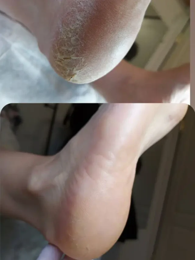 नरम और खूबसूरत एड़ियों के लिए अपनाएं ये घरेलू नुस्खे