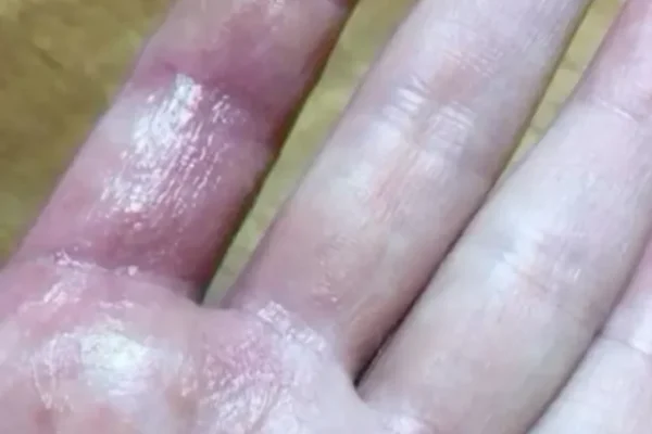 Burn hand remedies