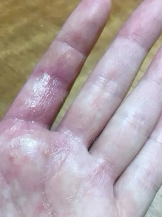 रसोई में जल गया है हाथ? तुरंत अपनाएं ये 5 घरेलू नुस्खे, नहीं पड़ेगा कोई निशान