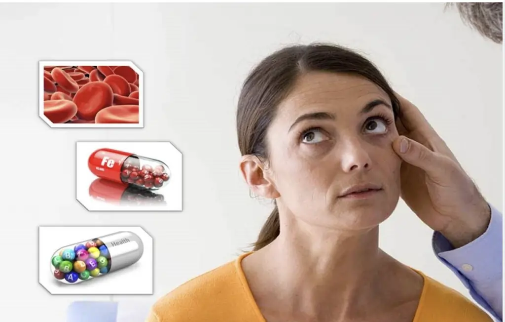 Anemia symptoms and diet, Anemia symptoms and diet