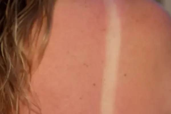 How to cure heat rash fast, Best treatment for summer rashes