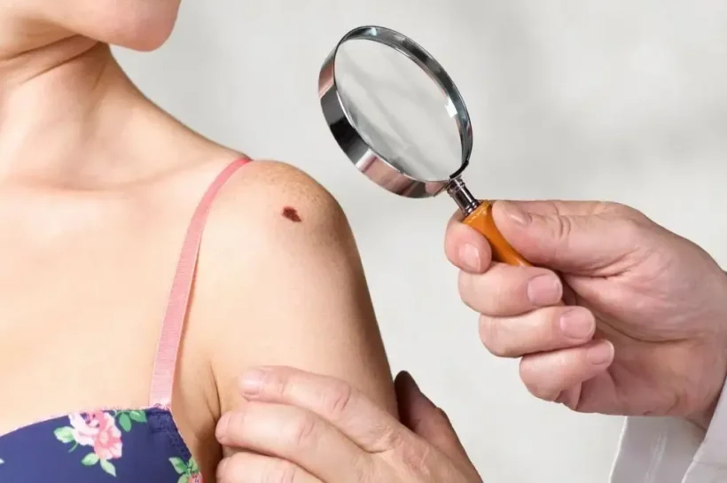 Skin mole health risk