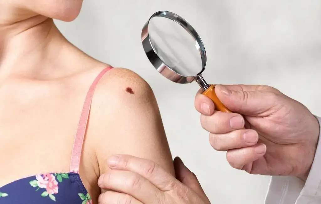 Skin mole health risk