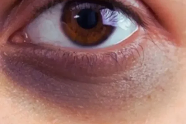 dark circles causes in hindi, dark circles causes in hindi