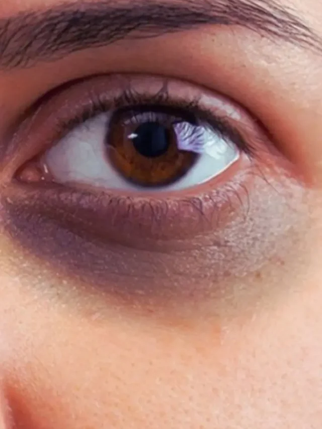 क्यों पड़ जाते हैं आंखों के नीचे काले घेरे? ये हैं बड़ी वजहें